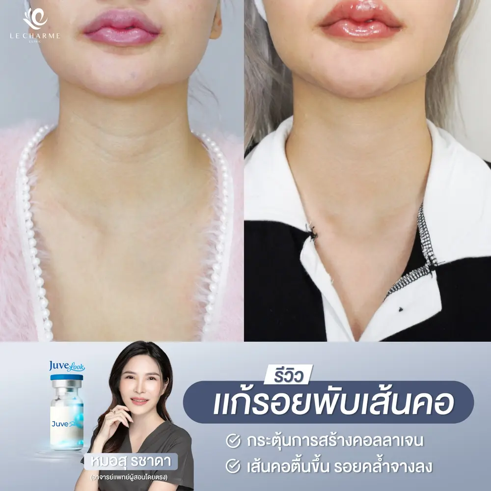รีวิวก่อนและหลังฉีด Juvelook แก้รอยพับเส้นคอ เคสที่ 1