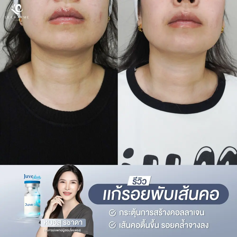 รีวิวก่อนและหลังฉีด Juvelook แก้รอยพับเส้นคอ เคสที่ 2