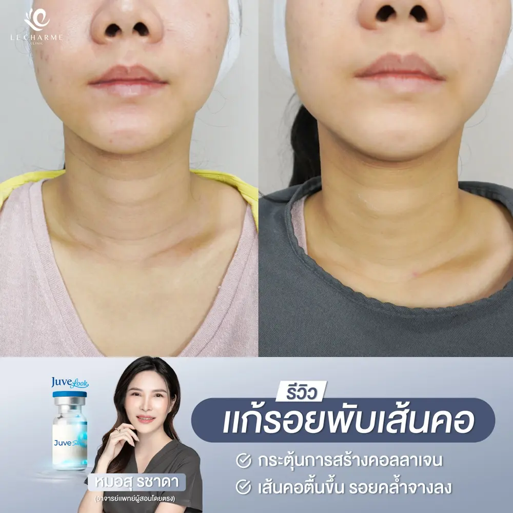 รีวิวก่อนและหลังฉีด Juvelook แก้รอยพับเส้นคอ เคสที่ 3