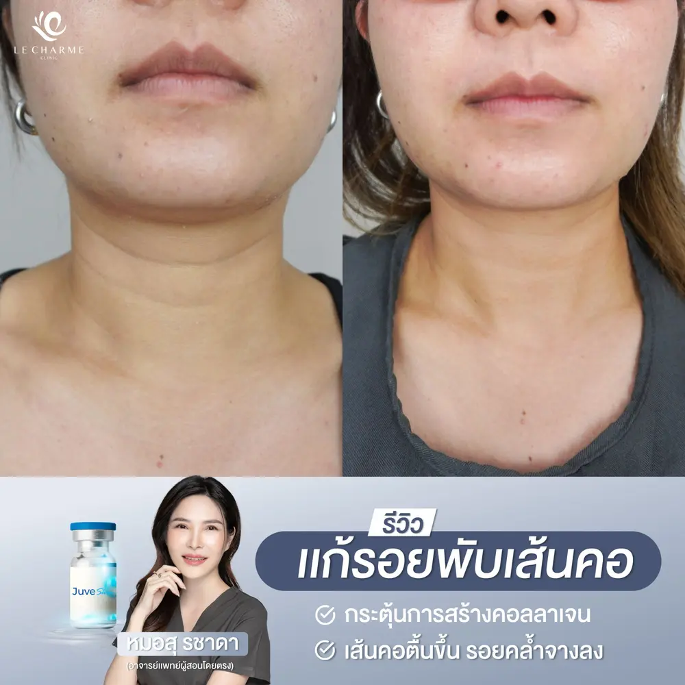 รีวิวก่อนและหลังฉีด Juvelook แก้รอยพับเส้นคอ เคสที่ 4