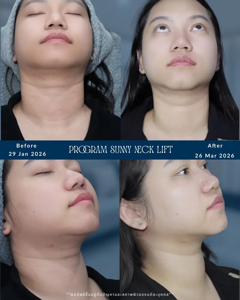 รีวิว Program Sunny Neck Lift ก่อน 29 ม.ค. 2026 และหลัง 26 มี.ค. 2026